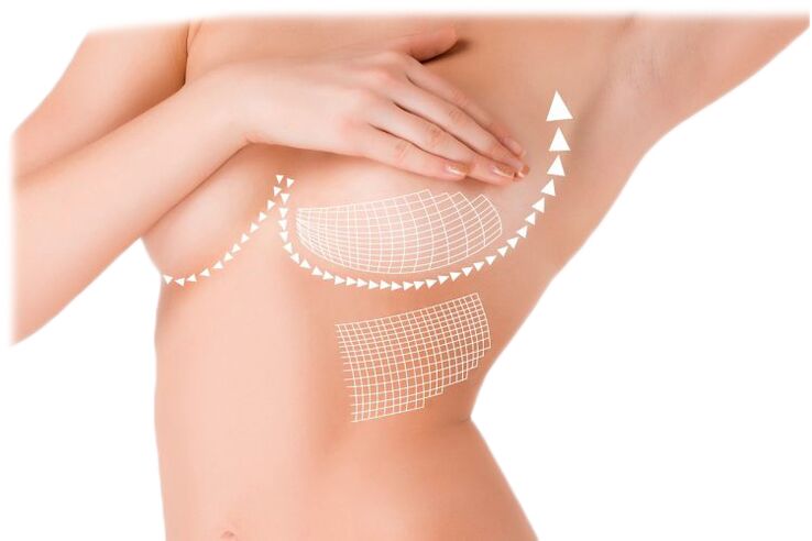 Acción de las cápsulas Mammax para el aumento de senos
