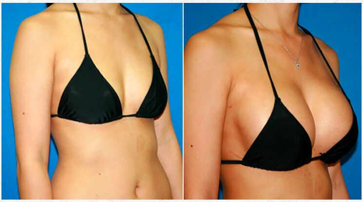 Antes y después del aumento de senos con cirugía plástica