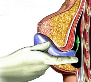implantación para agrandar los senos