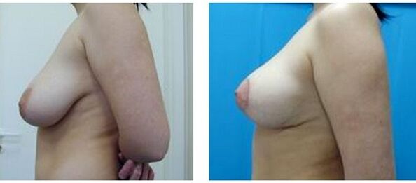 antes y después del aumento de senos quirúrgico