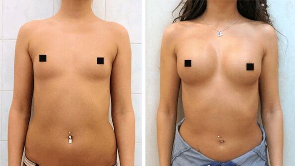 fotos antes y después del aumento de senos quirúrgico