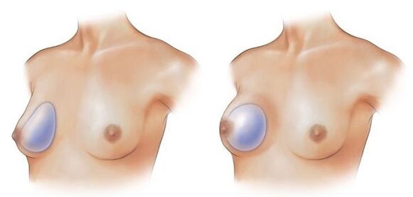 implantes redondos y en forma de gota para el aumento de senos