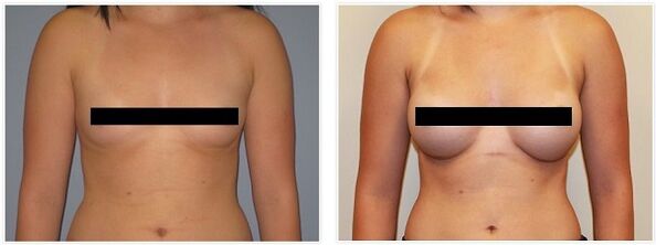 senos antes y después de la cirugía