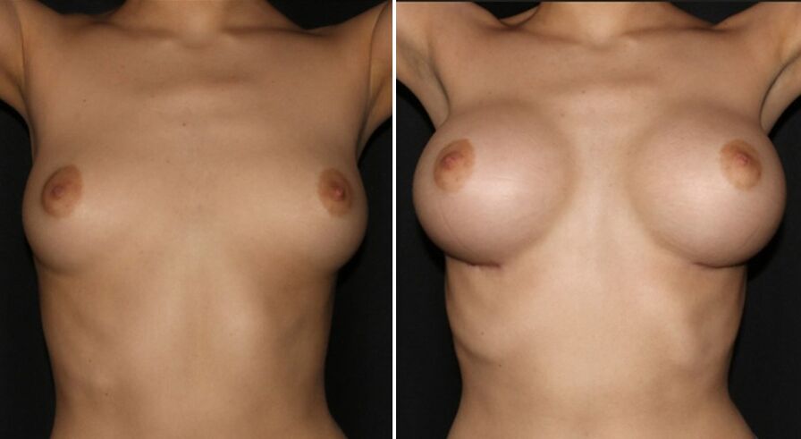 Antes y después de la cirugía de aumento de senos. 
